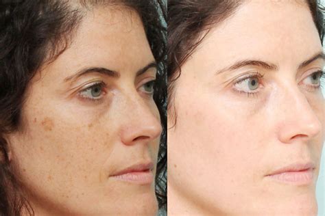 What are these Brown Spots on Face and How to Treat Them - HerGamut