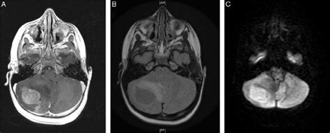 MRI confirmed a lesion in the right cerebellar hemisphere, with ...