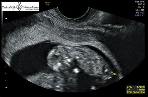 My Ultrasound of my cute little baby 3 months | Cute little baby, Little babies, Cute