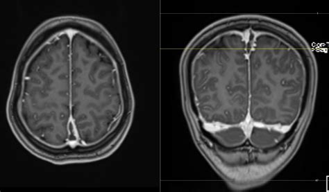 Intracranial Hypotension with Dural Sinus Thrombosis