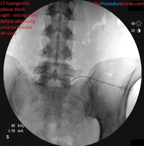 Hypogastric Plexus Block - Technique and Overview - The Procedure Guide