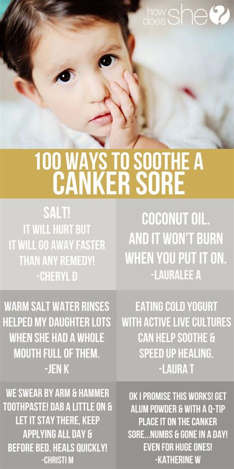 100 Ways to Soothe a Canker Sore | Canker sore, Health, Health remedies