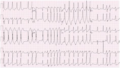 emDOCs.net – Emergency Medicine EducationECG Pointers: Atrial Fibrillation with Aberrancy ...