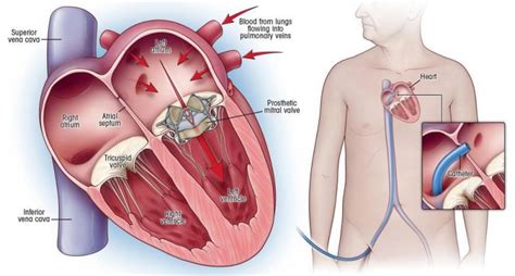 Transcatheter Mitral Valve Replacement: Procedure, Benefits & Recovery