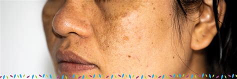 Skin Discoloration & Hyperpigmentation Treatments | Affiliated Dermatology