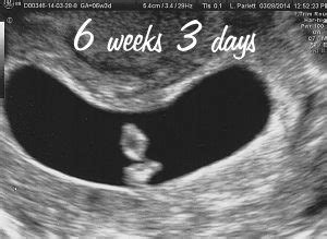 6-weeks-pregnant-ultrasound-1 | Pregnancy Health