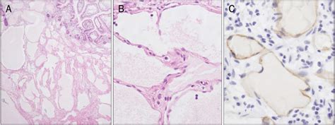 Microscopic findings. (A) There are many dilated lymphatic vessels ...