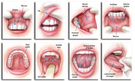 Signs of Oral Cancer — EMERGENCY DENTIST SYDNEY