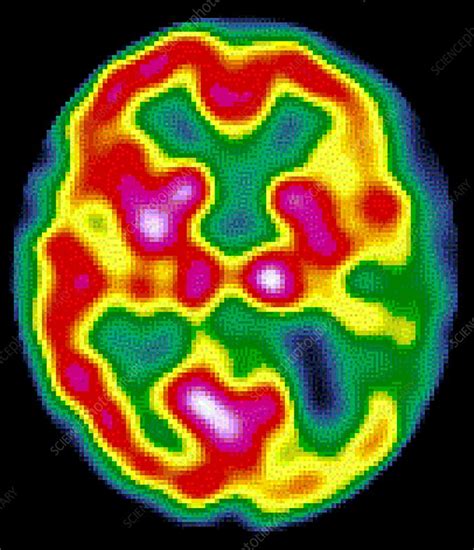 Brain disorder, SPECT scan - Stock Image - M210/0229 - Science Photo Library