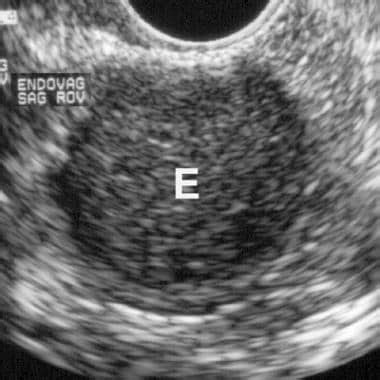 Imaging in Endometrioma/Endometriosis: Practice Essentials, Radiography, Computed Tomography