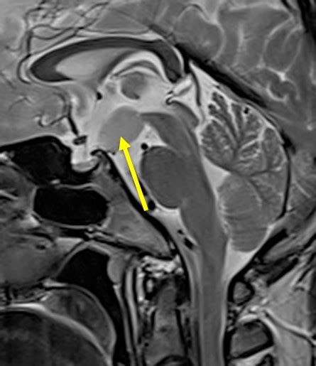 Hypothalamic hamartoma – Radiology Cases