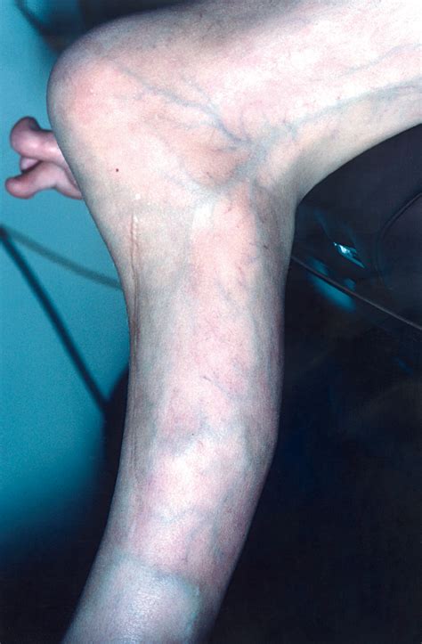 Cutaneous Manifestations of Proteus Syndrome: Correlations With General ...