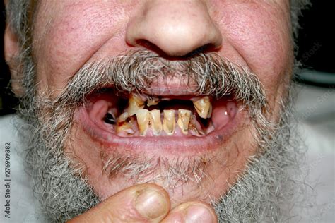 Rotten bad teeth. Beard and mustache. Caries. Periodontal disease. Dental tartar. Stock Photo ...