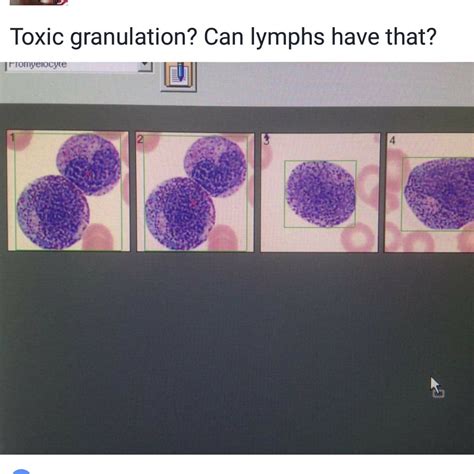 "Toxic granulation? Can lymphs have that?" : medlabprofessionals