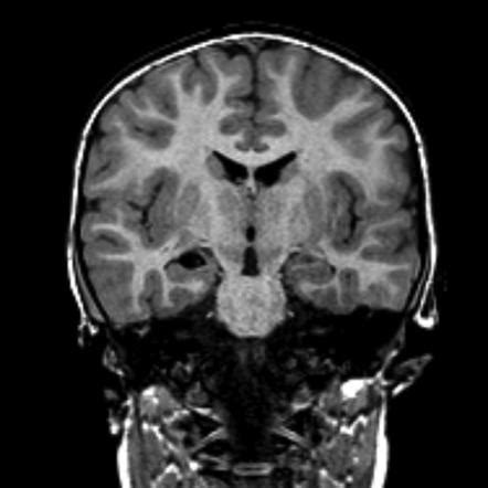 Choroidal fissure cyst | Radiology Reference Article | Radiopaedia.org