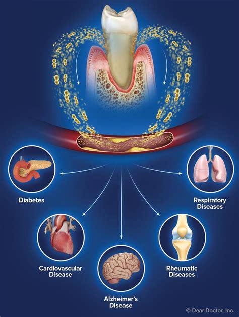 Gum Disease and Systemic Health