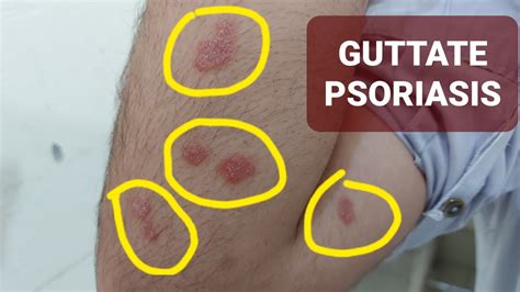 Guttate Psoriasis