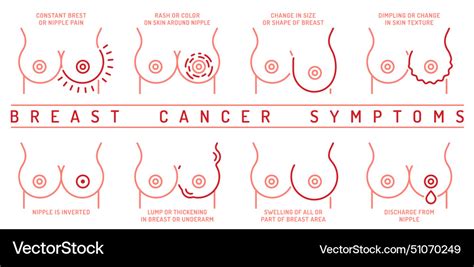 Breast carcinoma adenocarcinoma symptoms Vector Image