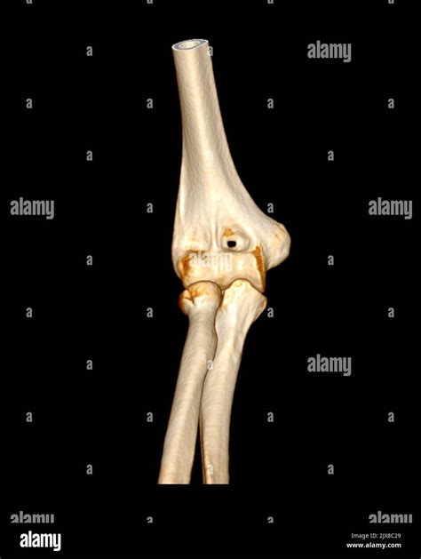 Tomografía computarizada Representación volumétrica Examen de la articulación del codo ...