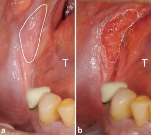 How to avoid iatrogenic lingual nerve injury in the retromolar area: an ...