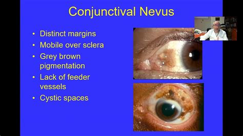 Primary Acquired Melanosis Treatment