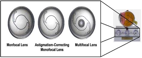 Premium IOL Options Lens Set | Gulden Ophthalmics