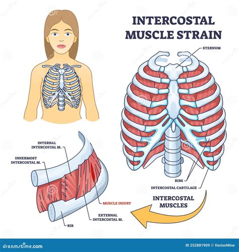 Intercostal Muscle Strain As Muscular Group in Chest Cavity Outline Diagram Stock Vector ...