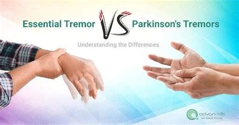 Essential Tremors versus Parkinson's | POSTEEZY