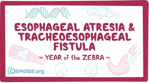 Esophageal atresia & tracheoesophageal fistula (Year of the Zebra) - YouTube