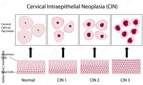 Cervical dysplasia stages and pap smear test Stock Illustration | Adobe Stock