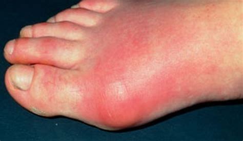 Gout – The 10 Most Common Symptoms – Page 3