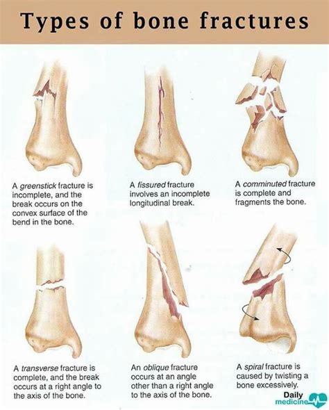 Different types of bone fracture - cyberhety