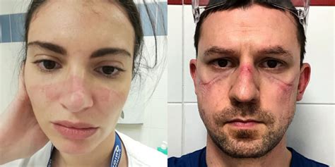 What it's like in Italy: Nurses share selfies of bruised faces after ...