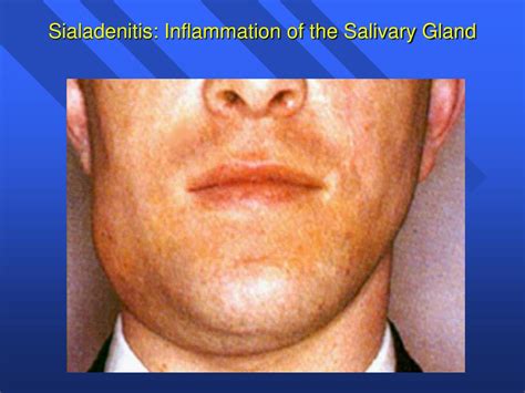 PPT - Introduction to the Salivary Glands PowerPoint Presentation - ID ...