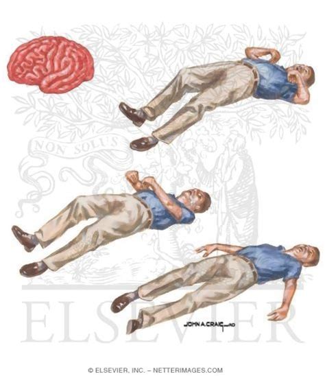 Generalized Tonic Clonic Seizures