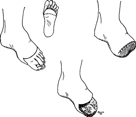 Transmetatarsal Amputations and Arterial Surgery in Diabetic Patients | NEJM