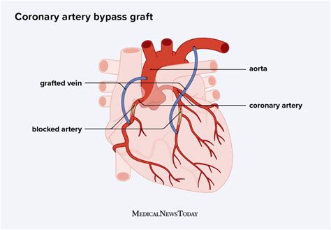 Heart bypass surgery: Procedure, recovery time, and risks