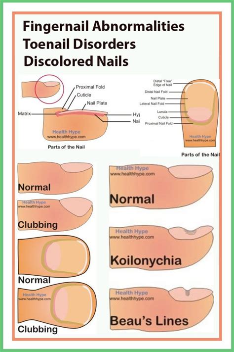 Fingernail Abnormalities, Toenail Disorders, Discolored Nails - Toenails Care | Toe nails, Nail ...