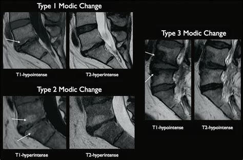 Imaging classification of endplate degenerative changes as proposed by... | Download Scientific ...