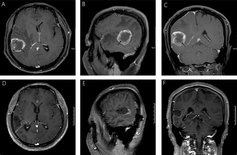 Frontiers | Primary Intracranial Leiomyosarcoma Secondary to Glioblastoma: Case Report and ...