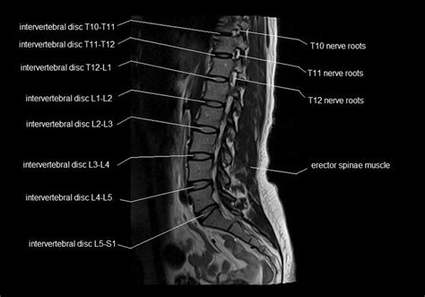 MRI spine anatomy | free MRI lumbar spine sagittal cross sectional ...