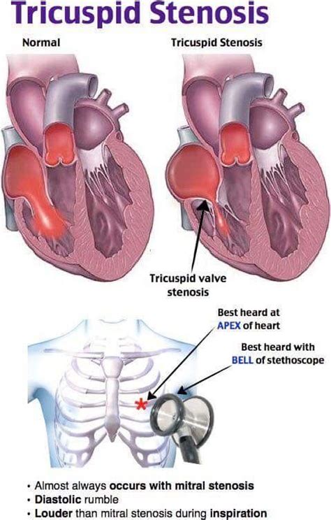 21 best Tricuspid Stenosis images on Pinterest | Cardiovascular disease, Heart disease and Body ...