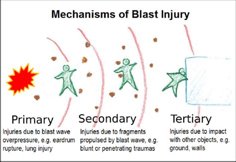 Schematic representation of blast injury mechanisms. | Download Scientific Diagram