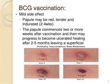 Bcg and hep b vaccination