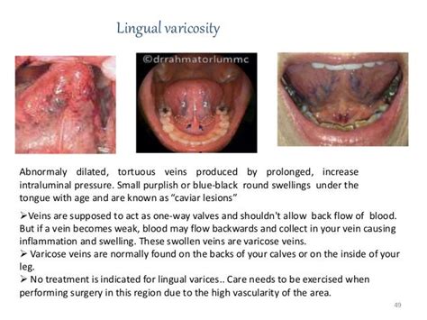 Venous drainage of head and neck