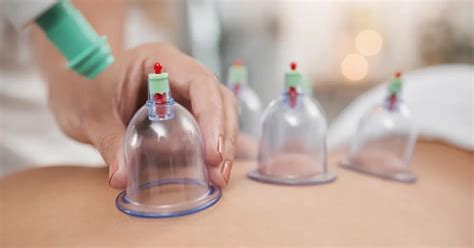 Cupping Therapy: An Ancient Healing Technique for Pain Relief