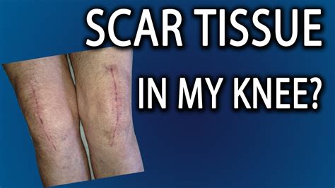 Scar Tissue In Knee: How Do I Get Rid Of It - YouTube