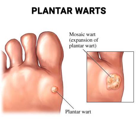 Plantar Warts - Business Promotion Network Community Article By Premier Podiatry: Wayne