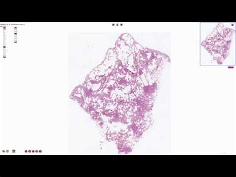 Miliary Tuberculosis - Histopathology - YouTube