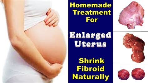 Enlarged Uterus, How To Reduce bulky Uterus - YouTube